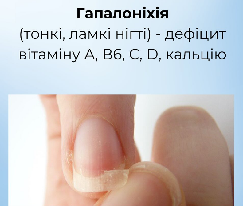 На проблему укажут ногти: как распознать пищевые дефициты и вернуть себе здоровье