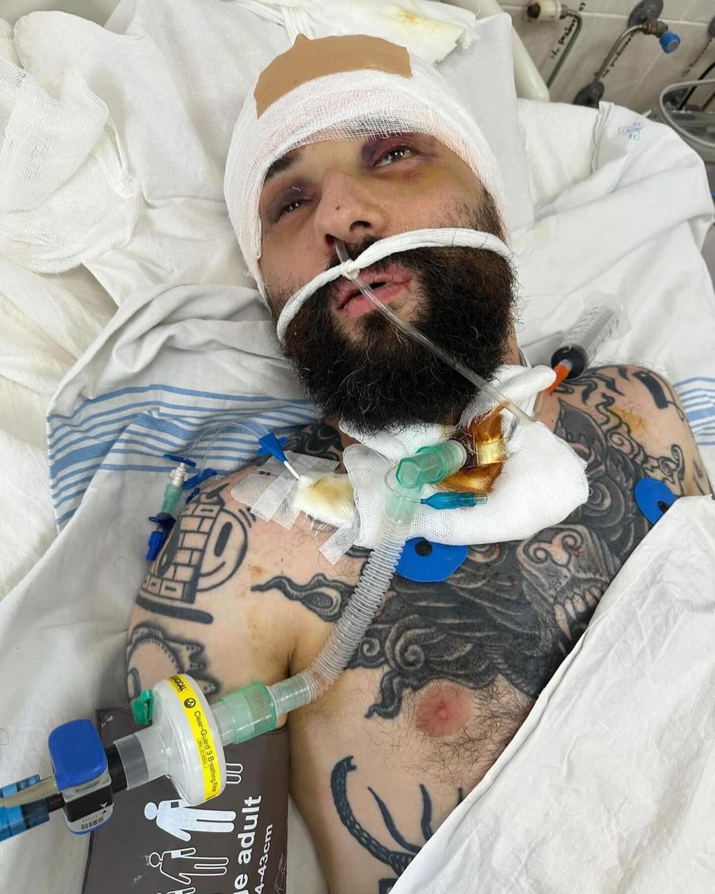 Розовий з "Ліги сміху" показав себе після коми й розкрив наслідки важкого поранення: "Уламок пробив шолом"